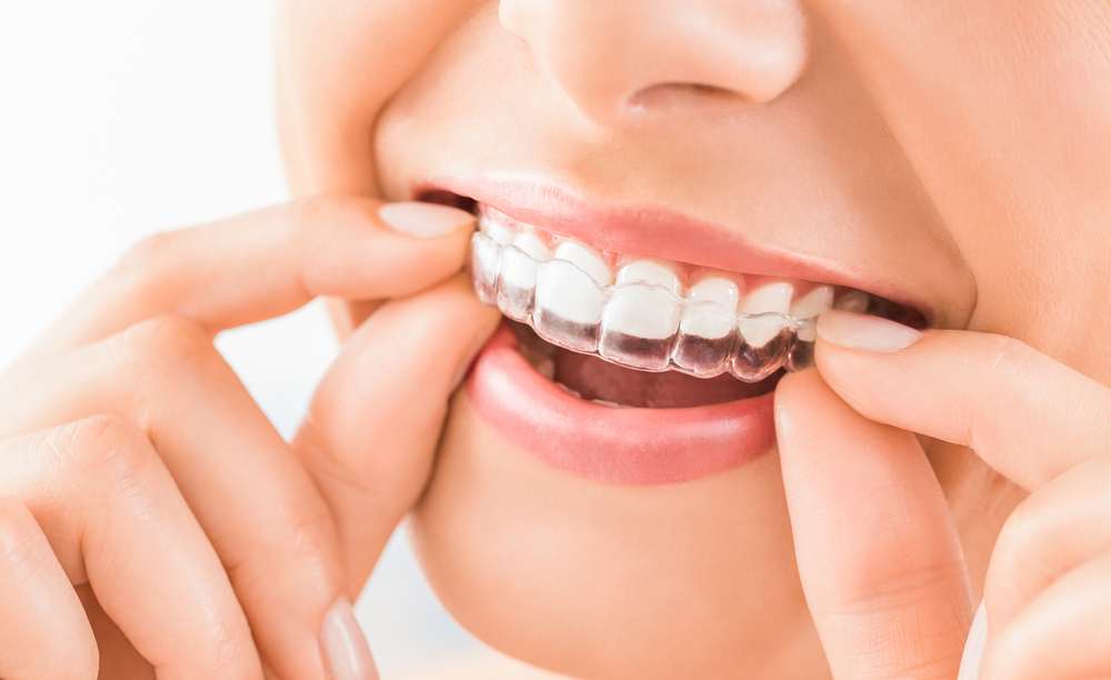 Invisalign in Carlsbad